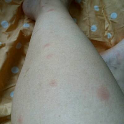 床单被套都洗了晒了,杀虫的药也喷了,还是没用呢
