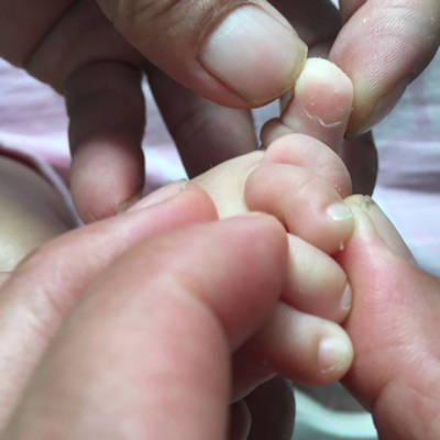 宝宝脚趾脱皮,四个半月轻微红,老是搓脚