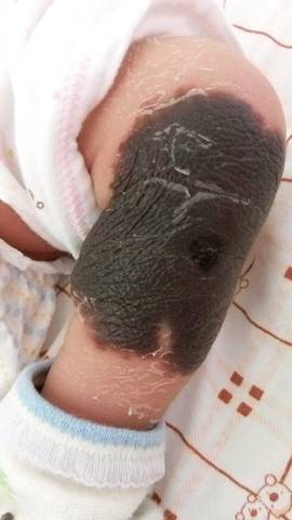 新生儿巨大黑色素痣