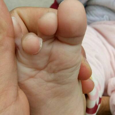 宝宝半岁手脚脱皮应该怎麼办?