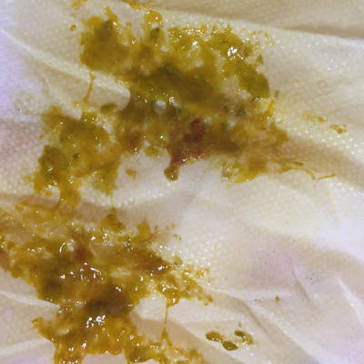 27天的宝宝拉屎偶尔带粘粘的血丝,喂的母乳,请问是怎麼回事?