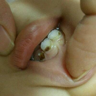 宝宝两岁了,牙齿有腐蚀现象,开始掉块,不知道是什么原因引起的,该怎么
