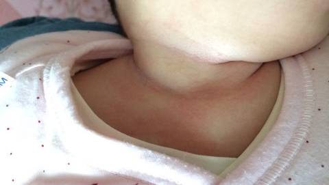 婴儿脖子真菌感染图片图片