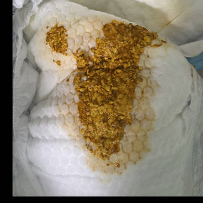 麻烦宝妈帮忙看看 宝宝大便正常吗?