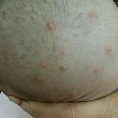 宝宝起疱疹的症状图片图片