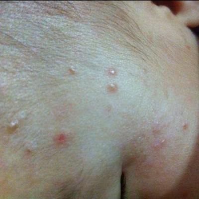 好多天了也不消.痒孩子一直挠