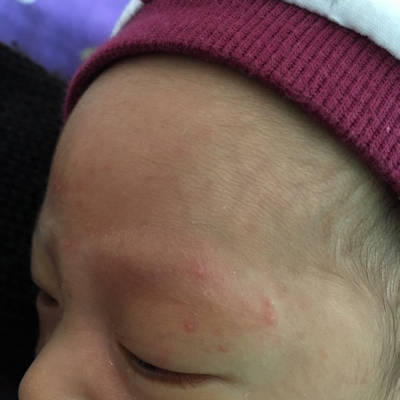 宝宝脸上长湿疹了怎麼办 需要搽点啥药吗