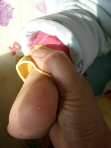 宝宝的后脚跟长了个白色痘痘,怎麼办