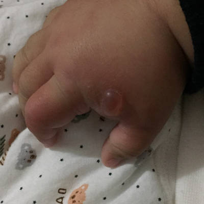 宝宝手被蚊子咬了,肿得厉害还有个大水泡,有点吓人,涂点什麼消肿呢