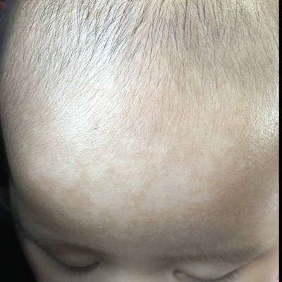 婴儿脖子汗斑图片图片
