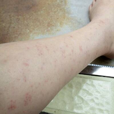 孕27周5,小腿和脚面长了很多红疹子,有点痒怎麼回事?