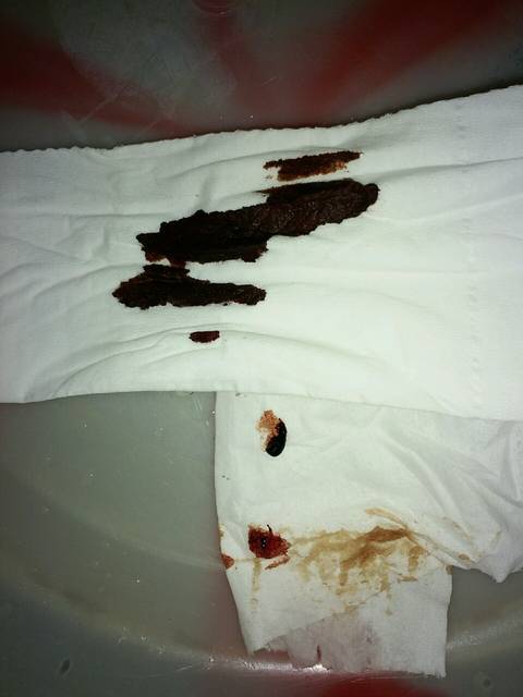 是不是吃了中药以后,宫腔里的积血排出来了?