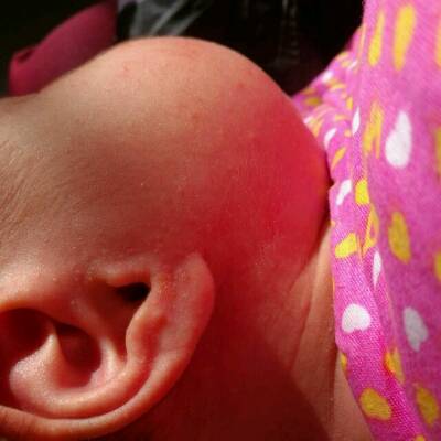宝宝29天,脸上耳朵后面脖子上起了好多小红疹样子的痘痘,很小,红红的