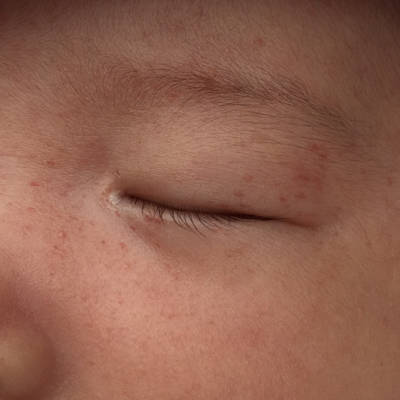 宝宝哭急了脸上出血点图片