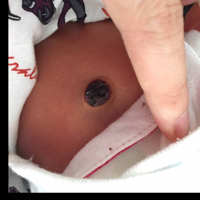 新生儿肚脐眼结痂出血图片