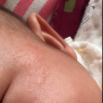 宝妈们,我们宝宝两个多月了,脸上起的小痘痘好像扩散了,一直没好,是