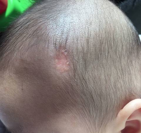 宝宝头上的疤痕是什么东西,会不会有什么影响?