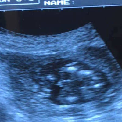 孕23周胎儿小鸡彩超图图片
