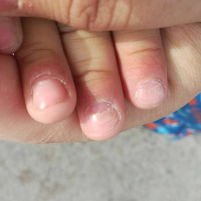儿童手指甲根部脱层图片