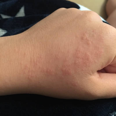 孕38周 手上突然发了很多疹子,如图,不知道是不是孕妇湿疹?