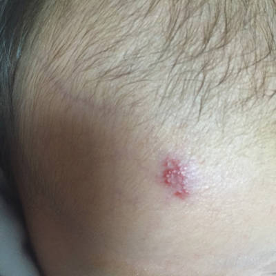宝宝额头上长了血管瘤,有相同宝宝的宝妈给点治疗的意见,