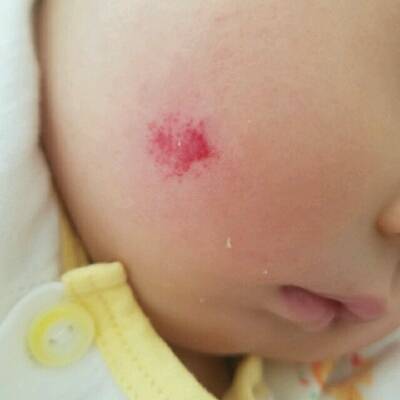 宝宝脸上湿疹红血丝图图片