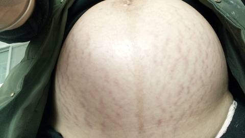 肚子现在跟个西瓜样,妊娠纹特别多,用什麼可以擦呀