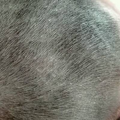 宝贝一个多月时头皮象有皮屑一样的东西,现在5个月了,还有,咋办,是什