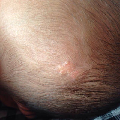 宝宝生下来头上就有一块这个跟疤痕一样的东西上头还不长头发今天第