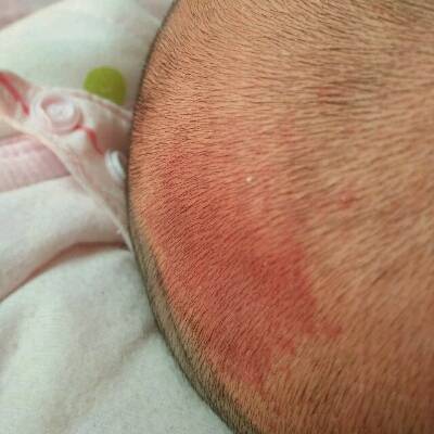 新生儿枕后红斑图片图片