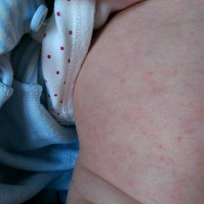 宝宝肚脐眼湿疹图片图片