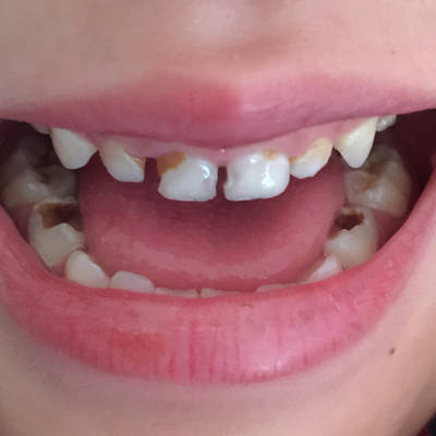 三岁半的宝宝牙齿这样,应该怎麼治疗啊一般,有知道的么