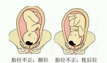 胎心在右下腹的胎位图图片