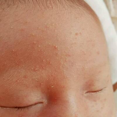 婴儿湿疹厚厚的黄结痂图片