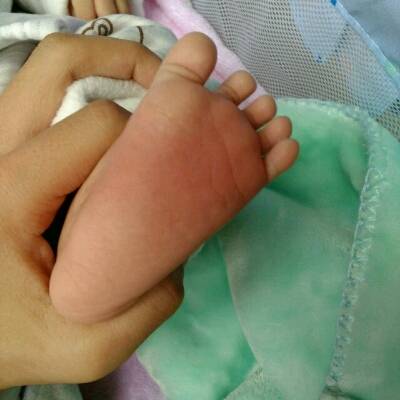 宝宝脚不知道被什麼咬了,脚底又肿又红,可以擦点什麼给他?3个月了.