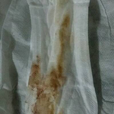 孕期十周了,前两周照b超有胎芽无胎心,今天下午小便时有褐色血出现,是