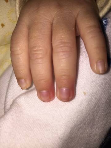 宝宝手指头红肿是怎麼回事