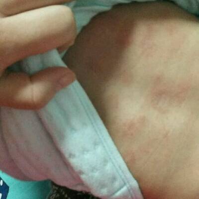 婴儿背部红疹图片