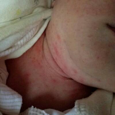 宝宝出生才11天脸上,脖子上满是红色颗粒,请问各位宝妈这是湿疹子颗粒
