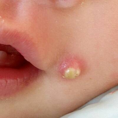 八个月宝宝嘴角疱疹图图片