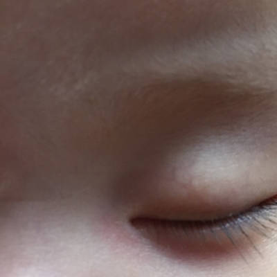 宝宝上眼皮有红血丝正常吗?