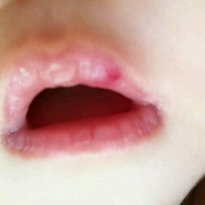 嘴唇长血管瘤初期图片图片
