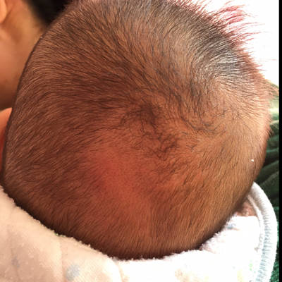 问题:宝宝三个月了,躺着的时候脑袋老是左右晃,后脑勺头发都磨没了,这