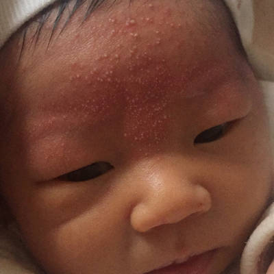 宝宝脸上长小米粒图片图片