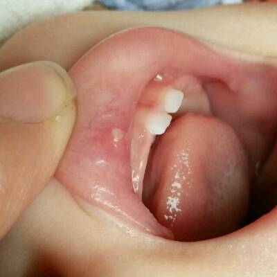 十个月宝宝口腔溃疡图图片