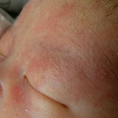 宝宝出生一周了,脸上和眼皮有透明的小水泡,头发里
