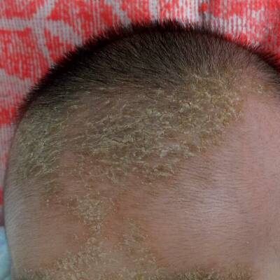 婴儿头皮上的黄珈图片图片