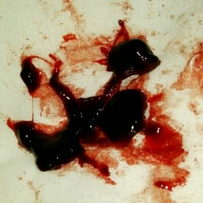 宫颈癌流血块的图片图片