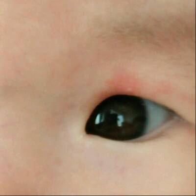宝宝眼睛上红色的是胎记吗?有时候看不到,哭的时候特别明显
