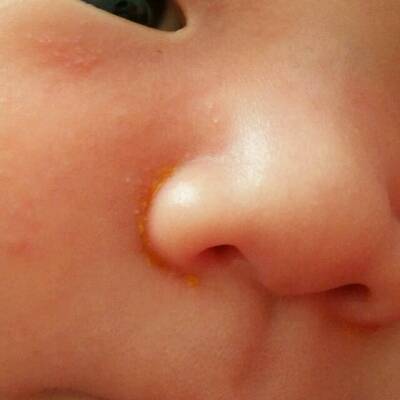 你好我想问一下我家宝宝鼻子这边的是什麼?对她有什麼影响嘛?